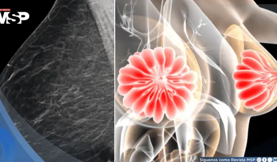 Descubren que la densidad mamaria podría dificultar la detección del cáncer de mama 