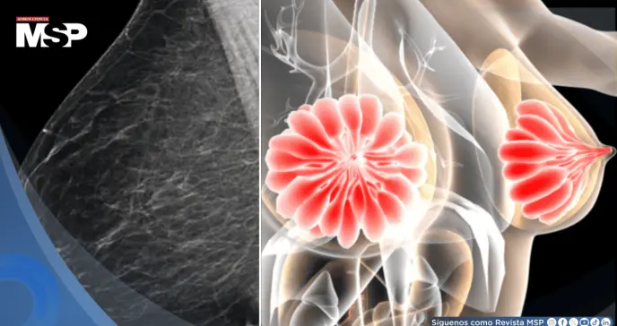 Descubren que la densidad mamaria podría dificultar la detección del cáncer de mama 