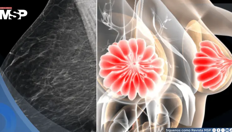 Descubren que la densidad mamaria podría dificultar la detección del cáncer de mama 