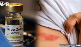 Vacuna recombinante contra el herpes zóster demuestra más del 50% de eficacia en inmunodeprimidos