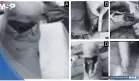 Rotura traumática distal del tendón de Aquiles en paciente de 10 años y reparación quirúrgica Krackow