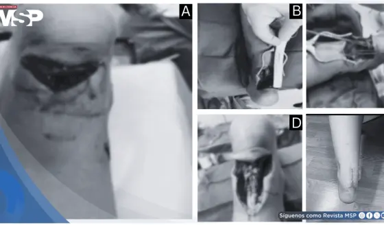 Rotura traumática distal del tendón de Aquiles en paciente de 10 años y reparación quirúrgica Krackow