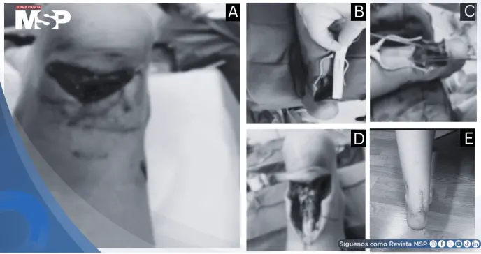 Rotura traumática distal del tendón de Aquiles en paciente de 10 años y reparación quirúrgica Krackow