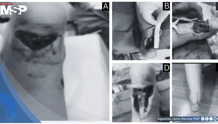 Rotura traumática distal del tendón de Aquiles en paciente de 10 años y reparación quirúrgica Krackow
