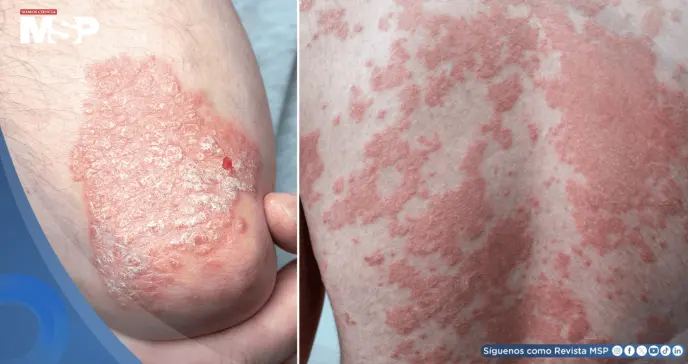 Estudio vincularía a la psoriasis con un riesgo elevado de padecer múltiples tipos de cáncer