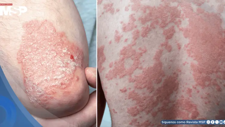 Estudio vincularía a la psoriasis con un riesgo elevado de padecer múltiples tipos de cáncer