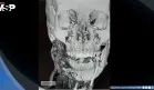 Rara malformación arteriovenosa mandibular causa hemorragia masiva en una mujer embarazada a término
