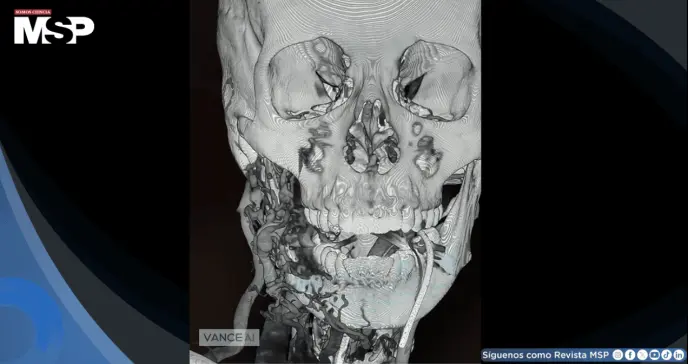 Rara malformación arteriovenosa mandibular causa hemorragia masiva en una mujer embarazada a término