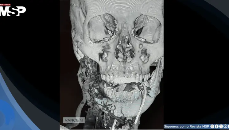 Rara malformación arteriovenosa mandibular causa hemorragia masiva en una mujer embarazada a término