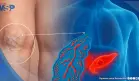 ¿Coágulo doloroso en la pierna? Podría ser la primera señal de cáncer de páncreas