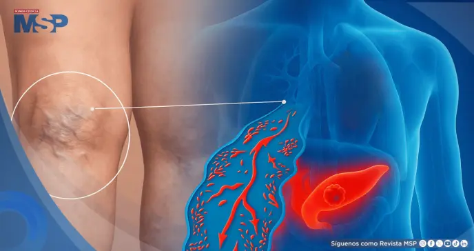 ¿Coágulo doloroso en la pierna? Podría ser la primera señal de cáncer de páncreas ¿Coágulo doloroso en la pierna? Podría ser la primera señal de cáncer de páncreas