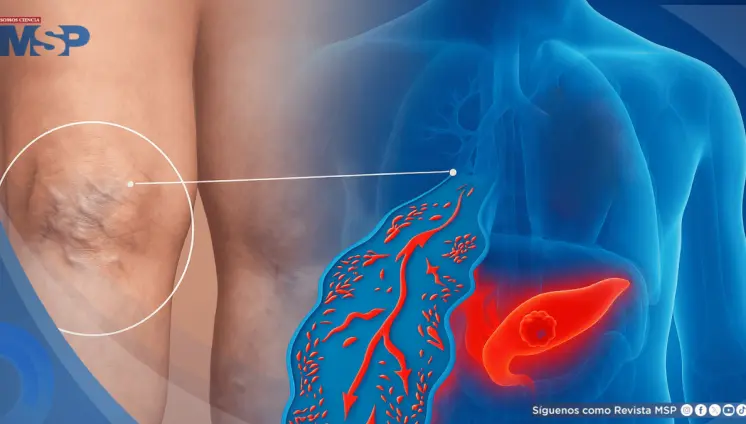 ¿Coágulo doloroso en la pierna? Podría ser la primera señal de cáncer de páncreas