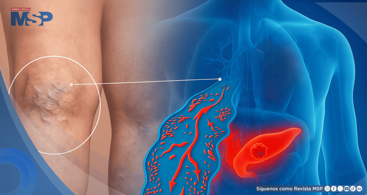 ¿Coágulo doloroso en la pierna? Podría ser la primera señal de cáncer de páncreas