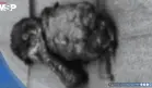 Hombre con diabetes y fallo renal desarrolla gangrena genital tras cirugía por calcifilaxis 