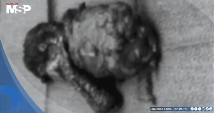 Hombre con diabetes y fallo renal desarrolla gangrena genital tras cirugía por calcifilaxis 