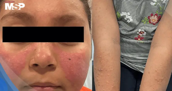 Erupción facial fotosensible lleva al diagnóstico de lupus eritematoso sistémico en paciente pediátrica