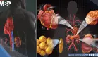 Qué es el síndrome cardiovascular renal-metabólico, que podría afectar a 9 de cada 10 adultos