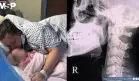 Mujer presenta fractura cervical tras bostezar: Desplazamiento de vértebras  C6 y C7 provocó parálisis