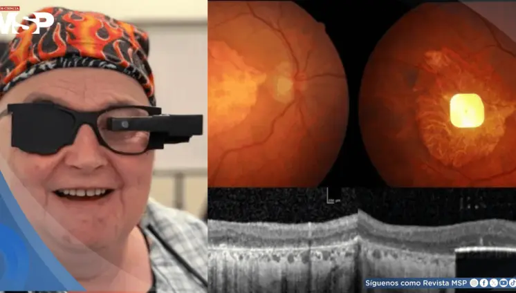 Desarrollan implante fotovoltaico que devuelve la capacidad de leer a personas con degeneración macular