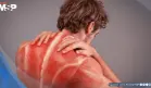 Qué son los puntos gatillo o nudos musculares que causan dolor intenso y cómo tratarlos