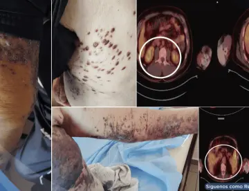 Detectan 3 tipos distintos de cáncer cutáneo en paciente de 83 años con problemas cardiacos 