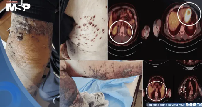 Detectan 3 tipos distintos de cáncer cutáneo en paciente de 83 años con problemas cardiacos  Detectan 3 tipos distintos de cáncer cutáneo en paciente de 83 años con problemas cardiacos