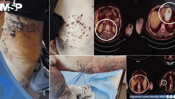 Detectan 3 tipos distintos de cáncer cutáneo en paciente de 83 años con problemas cardiacos 