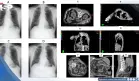 Náuseas y sudoración súbita durante radioterapia resultó en compresión idiopática de vena cava inferior