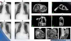 Náuseas y sudoración súbita durante radioterapia resultó en compresión idiopática de vena cava inferior