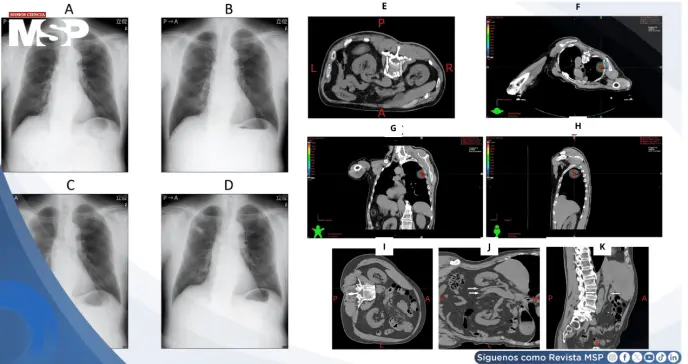 Náuseas y sudoración súbita durante radioterapia resultó en compresión idiopática de vena cava inferior