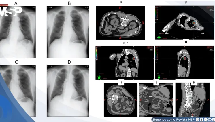 Náuseas y sudoración súbita durante radioterapia resultó en compresión idiopática de vena cava inferior