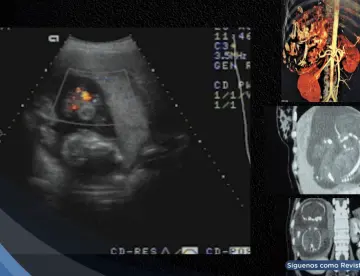 Diagnostican embarazo intrahepático de 23 semanas en mujer de 27 años: el feto crecía dentro del hígado