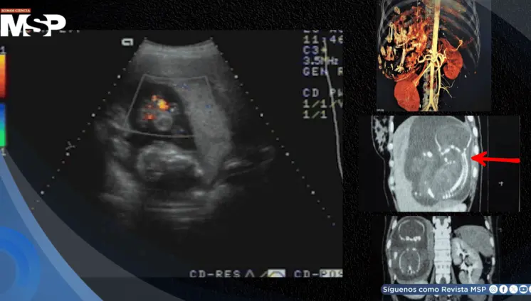 Diagnostican embarazo intrahepático de 23 semanas en mujer de 27 años: el feto crecía dentro del hígado
