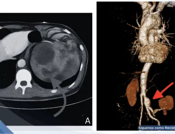 Aneurisma roto simuló infección urinaria: Dolor lumbar e hidronefrosis confundieron el diagnóstico