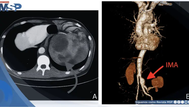Aneurisma roto simuló infección urinaria: Dolor lumbar e hidronefrosis confundieron el diagnóstico