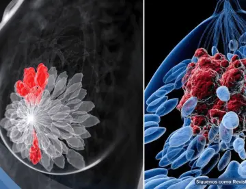 Desarrollan terapia de anticuerpos que activa el sistema inmune y frena el cáncer de mama triple negativo