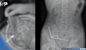 Adolescente ingirió más de 100 imanes de neodimio: La cadena afectó irreparablemente el intestino