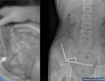 Adolescente ingirió más de 100 imanes de neodimio: La cadena afectó irreparablemente el intestino