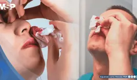 Por qué nunca debe inclinar la cabeza hacia atrás durante una hemorragia nasal