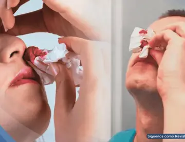 Por qué nunca debe inclinar la cabeza hacia atrás durante una hemorragia nasal
