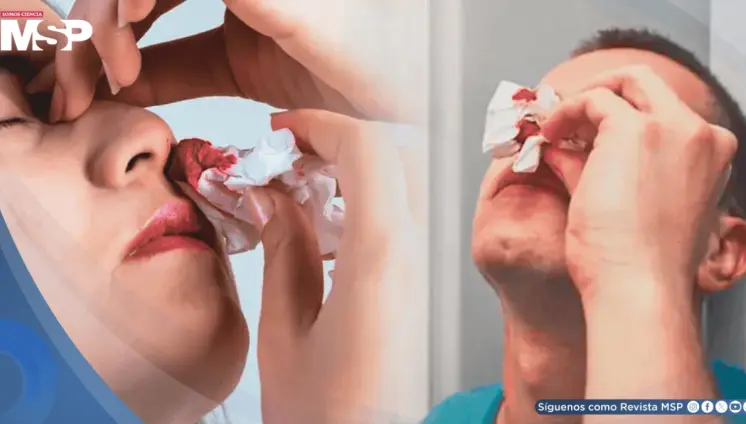 Por qué nunca debe inclinar la cabeza hacia atrás durante una hemorragia nasal