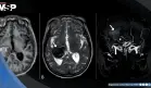 Dolor de cabeza y visión borrosa revelaron un aneurisma cerebral gigante en un hombre de 64 años