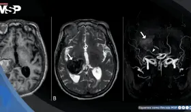 Dolor de cabeza y visión borrosa revelaron un aneurisma cerebral gigante en un hombre de 64 años