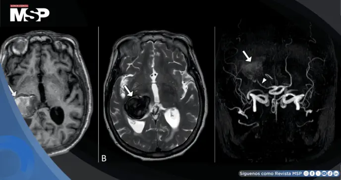 Dolor de cabeza y visión borrosa revelaron un aneurisma cerebral gigante en un hombre de 64 años