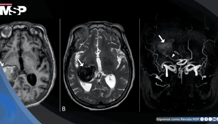 Dolor de cabeza y visión borrosa revelaron un aneurisma cerebral gigante en un hombre de 64 años