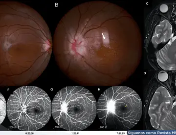 Disminución visual aguda y neurorretinitis asociada a Bartonella henselae transmitida por lamidas de gato