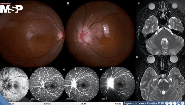 Disminución visual aguda y neurorretinitis asociada a Bartonella henselae transmitida por lamidas de gato