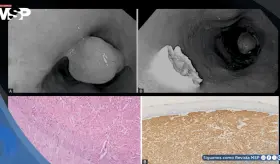 Mujer es diagnosticada con un pólipo tipo molusco en el esófago tras presentar disfagia y pérdida de peso