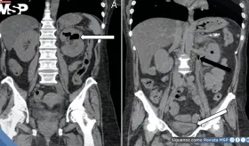 Pielitis enfisematosa fulminante en paciente diabética: Diagnóstico y resolución tras drenaje percutáneo
