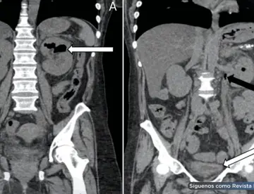 Pielitis enfisematosa fulminante en paciente diabética: Diagnóstico y resolución tras drenaje percutáneo
